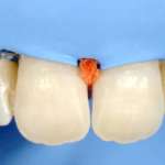 Approccio mininvasivo per il trattamento delle lesioni bianche dello smalto tecnica di erosione-infiltrazione