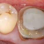 Cementazione adesiva su denti naturali