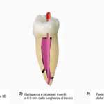 Una nuova tecnica per utilizzare i biosealers in modo tridimensionale