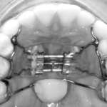 Il controllo della verticalità nel paziente ortodontico