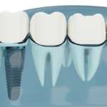 Workflow digitale in ambito implantare Dm_il dentista moderno_workflow digitale