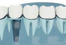 Workflow digitale in ambito implantare Dm_il dentista moderno_workflow digitale