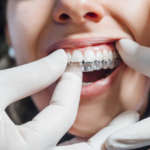 Risposta muscolare al trattamento con clear aligner Clear aligner