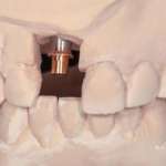 Protesi avvitata con unità transepiteliale uso di diverse interfacce protesiche