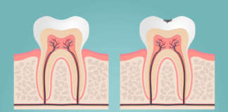 Stima della carcinogenesi da radiazioni in ambito dentale e norme di radioprotezione dm_il-dentista-moderno_cariorecettività_radioprotezione