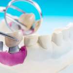 L’implantologia ceramica in un corso “Fad”