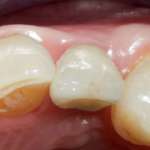 Socket Preservation nel settore frontale per ottenere estetica e funzione