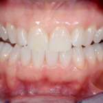 Sbiancamento dentale, come ottenere risultati duraturi, in modo prevedibile, senza fare danni