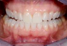 Sbiancamento dentale, come ottenere risultati duraturi, in modo prevedibile, senza fare danni