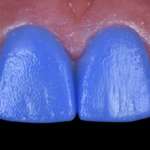 La tecnica ‘’Blue path mock-up’’: aumentare la qualità e ottimizzare i tempi nella preparazione di faccette dentali