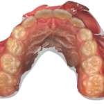 Trattamento Invisalign in pazienti autistici