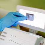 Fisiopatologia del riassorbimento radicolare Riassorbimento radicolare