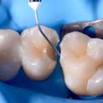 Restauri diretti in composito bulk-fill a viscosità variabile