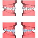 Le agenesie dei laterali: trattamento multidisciplinare ortodontico-chirurgico