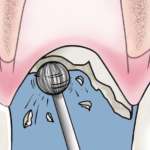 Impianti post-estrattivi immediati: unica scelta implantare?