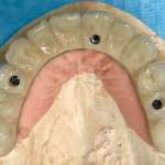 Riabilitazione implantoprotesica mediante metodica avvitata Cad-Cam twOne System