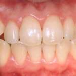 Un coadiuvante nel trattamento non chirurgico delle patologie parodontali