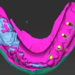 Riabilitazione implantoprotesica con metodica computer guidata un caso clinico