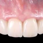 Impianti post-estrattivi nel settore estetico e riassorbimento crestale