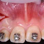 Chirurgia piezoeletrica: quali applicazioni?