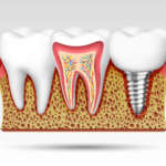 Digitale in implantologia DM_il dentista moderno_fallimento implantare
