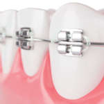 Recupero del canino incluso combinato con espansione rapida palatina Dm_il dentista moderno_canino incluso