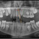 Intercettare l’inclusione del canino superiore mediante estrazione precoce del canino deciduo