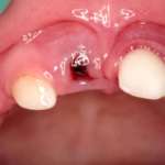 Gestione del trauma dei denti decidui nella prima infanzia