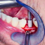 Limiti attuali della chirurgia implantare guidata DM_il dentista moderno_chirurgia implantare_nervo alveolare inferiore