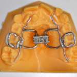 Benefici correlati all’utilizzo del flusso digitale nel trattamento della disgiunzione palatale