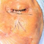 Nuovi protocolli di gestione delle lesioni nervose del cavo orale