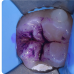 La gestione clinica e operativa dei solchi e delle fossette pigmentate: il corso dedicato
