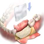 Membrane e materiali da innesto: quali novità?