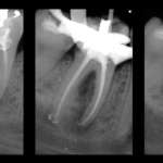 Strumentazione mista e tecnica delle conicità invertite nei canali curvi