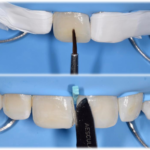Le determinanti di forma e di colore per il successo del restauro estetico anteriore in composito