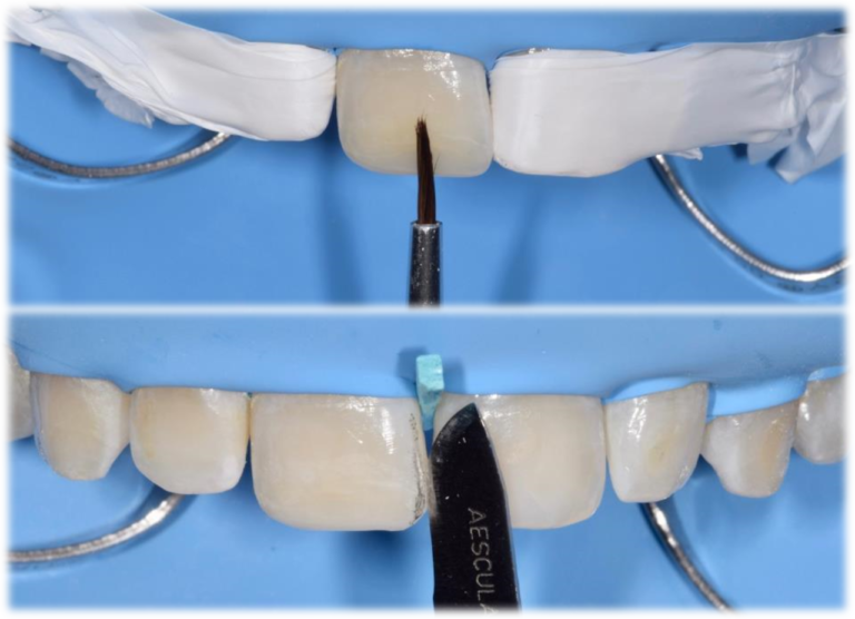 Le determinanti di forma e colore per il successo del restauro estetico anteriore in composito