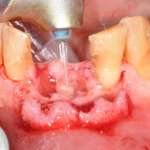 Impianti immediati post-estrattivi in siti infetti con ausilio del laser Er,Cr: YSGG (2.780nm)