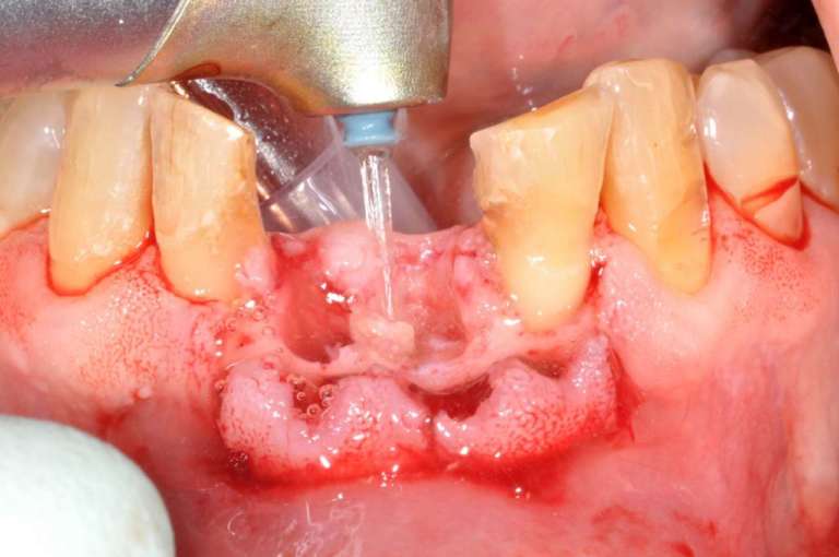 Impianti immediati post-estrattivi in siti infetti con ausilio del laser Er,Cr: YSGG (2.780nm)