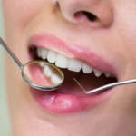 Microinfiltrazione di restauri di II classe in resina composita bulk-fill