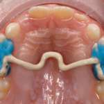 Ortodonzia pediatrica quando “less is better”