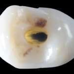 Accuratezza delle guide endodontiche stampate in 3D per la preparazione della cavità di accesso