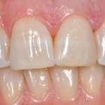 Il recupero estetico-funzionale del settore anteriore con tecniche minimamente invasive riabilitazione estetica