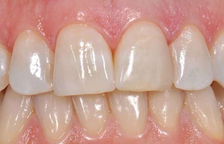 Il recupero estetico-funzionale del settore anteriore con tecniche minimamente invasive