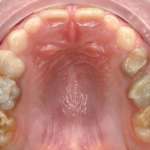 Valutazione dell’incidenza di carie nei pazienti con ipomineralizzazione di molari e incisivi (MIH)