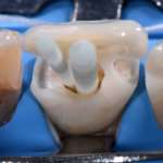 Le fondamenta del restauro estetico: i perni in fibra di vetro PERNI DI FIBRA DI VETRO