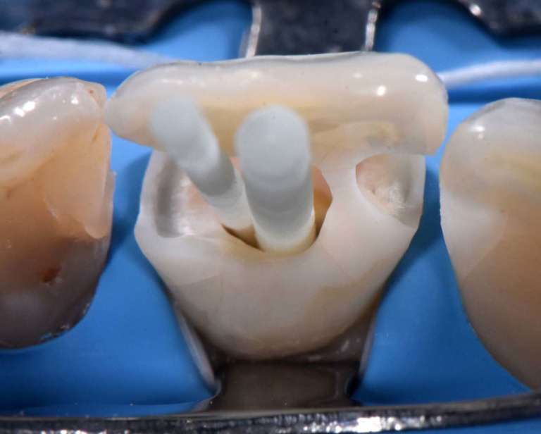 Le fondamenta del restauro estetico: i perni in fibra di vetro