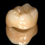 Restauri biomimetici cementati adesivamente nei denti latero-posteriori compromessi