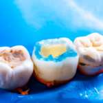 Nuovi materiali da adesione: caratteristiche e prospettive