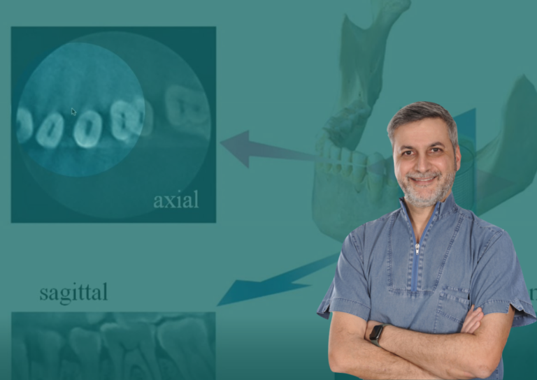 Il ruolo della CBCT nella qualità del trattamento endodontico