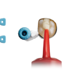 Restaurativa: un nuovo composito ibrido autoadesivo